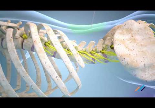 3D animation of operational techniques in spinal surgery